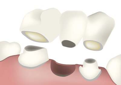 If you are missing teeth in San Antonio, TX and are looking for a cost-effective teeth replacement option, a dental bridge may be right for you.