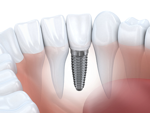 A diagram of teeth with an implant showing through the gums representing dental implant placement in San Antonio, TX.
