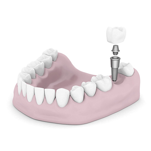 Single Tooth Replacement with Dental Implant by San Antonio Dentist at Excellent Dental Specialists.