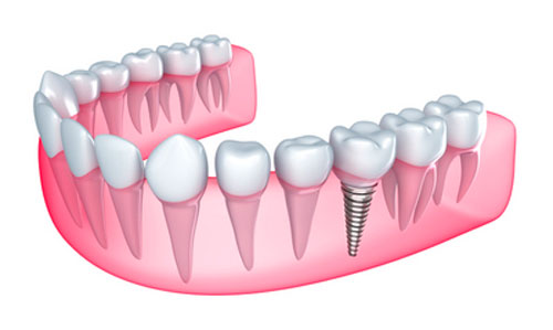 Dental Implants Diagram by San Antonio Dentist at Excellent Dental Specialists.