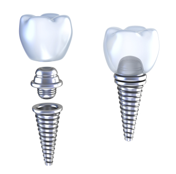 Dental implant diagram by periodontist in San Antonio, TX.