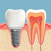 Dental implants diagram by periodontist in San Antonio, TX.