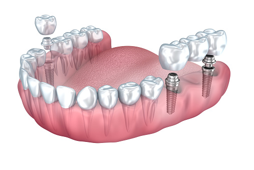Multiple Tooth Replacement with Dental Implants by San Antonio Dentist at Excellent Dental Specialists.