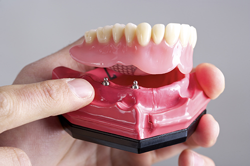 San Antonio dentist holding a model of a dental implant retained dentures to show patients at Excellent Dental Specialists.