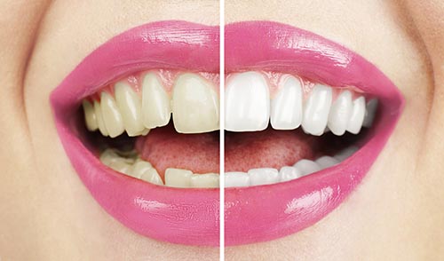 An image of a woman's smile with half her mouth with dingy teeth, and the other half after cosmetic whitening