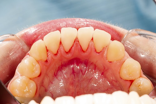 Gum Disease Excellent Dental Specialists TX 78232-4354