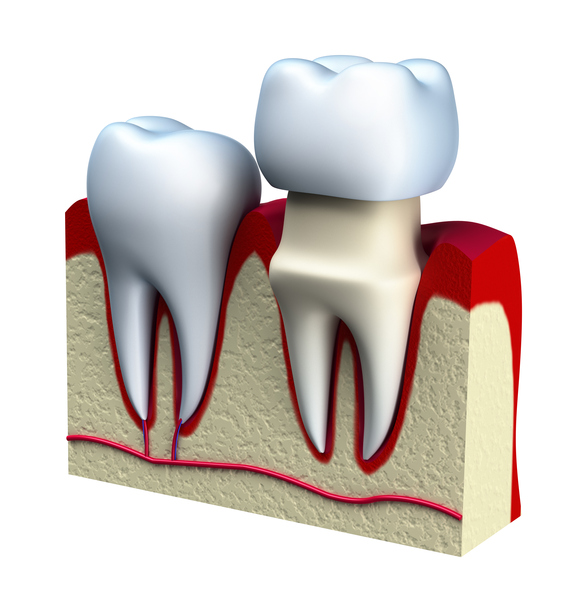 Graphic of dental crown.