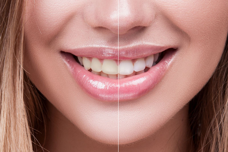 Teeth Whitening Before and After Graphic