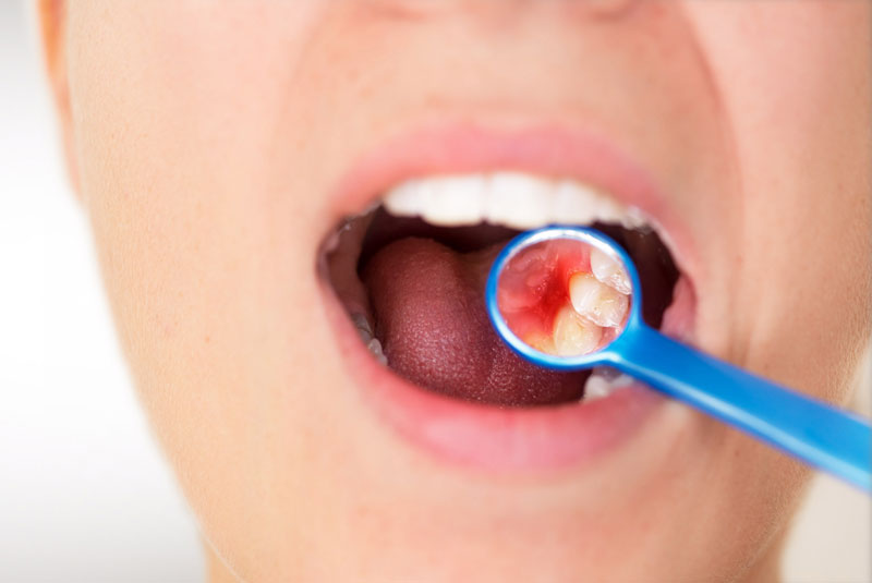 Dental Patient Needing Gum Disease Treatment
