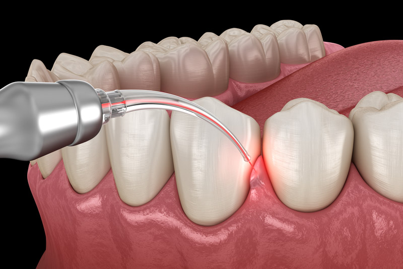 Gum Disease Laser Treatment