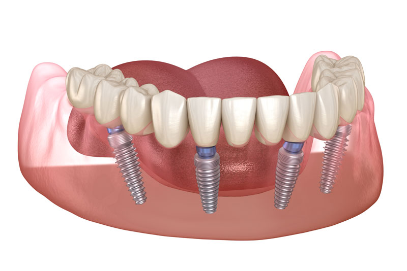 All-On-4 Dental Implant Full Arch