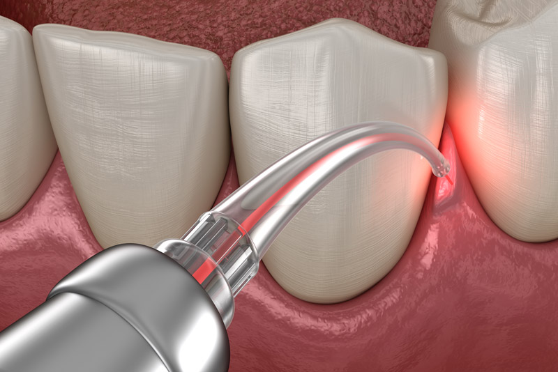 Gum Disease Laser Treatment