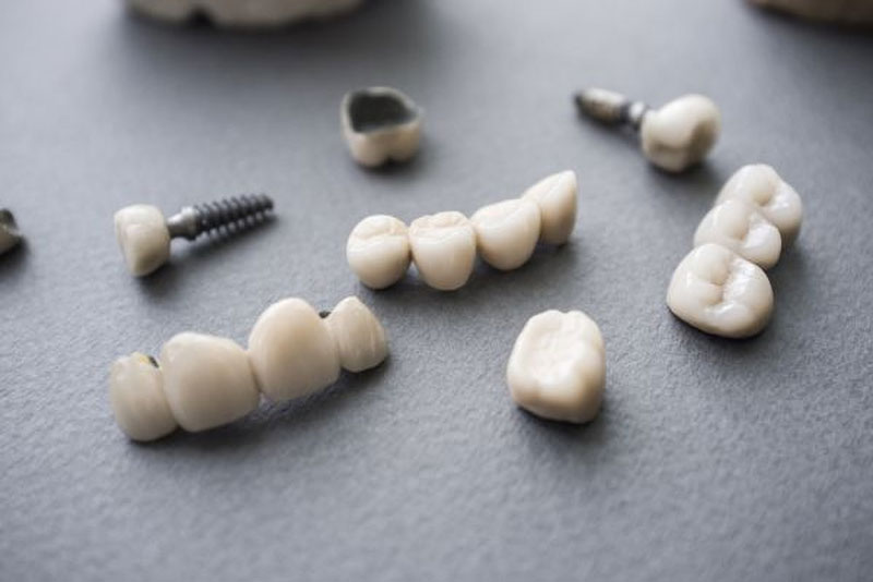 Dental Crowns, Bridges, And Implants On A Table