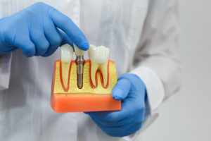 dental implant model of a bone cutaway