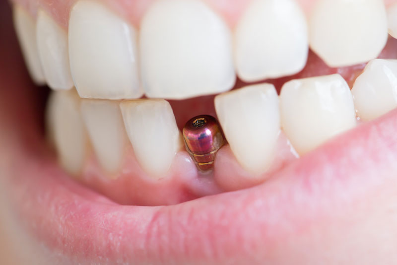 along with other natural teeth, image of a single dental implant post inside of a dental patients gums
