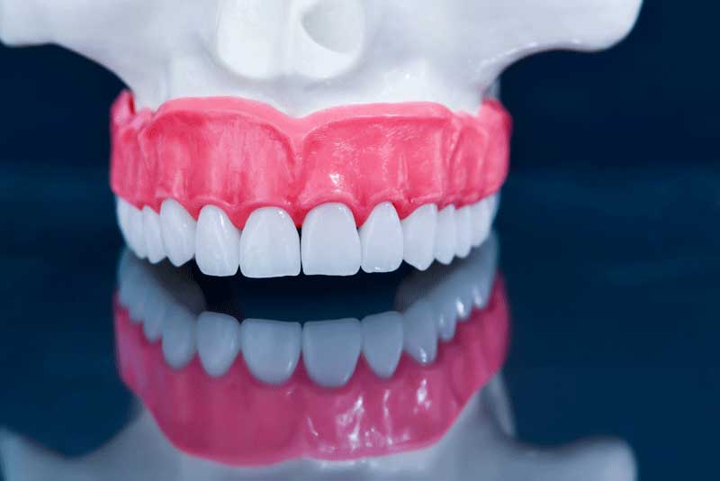 an all on 4 dental implants model