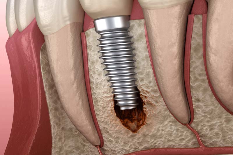a dental implant affected by peri implantitis