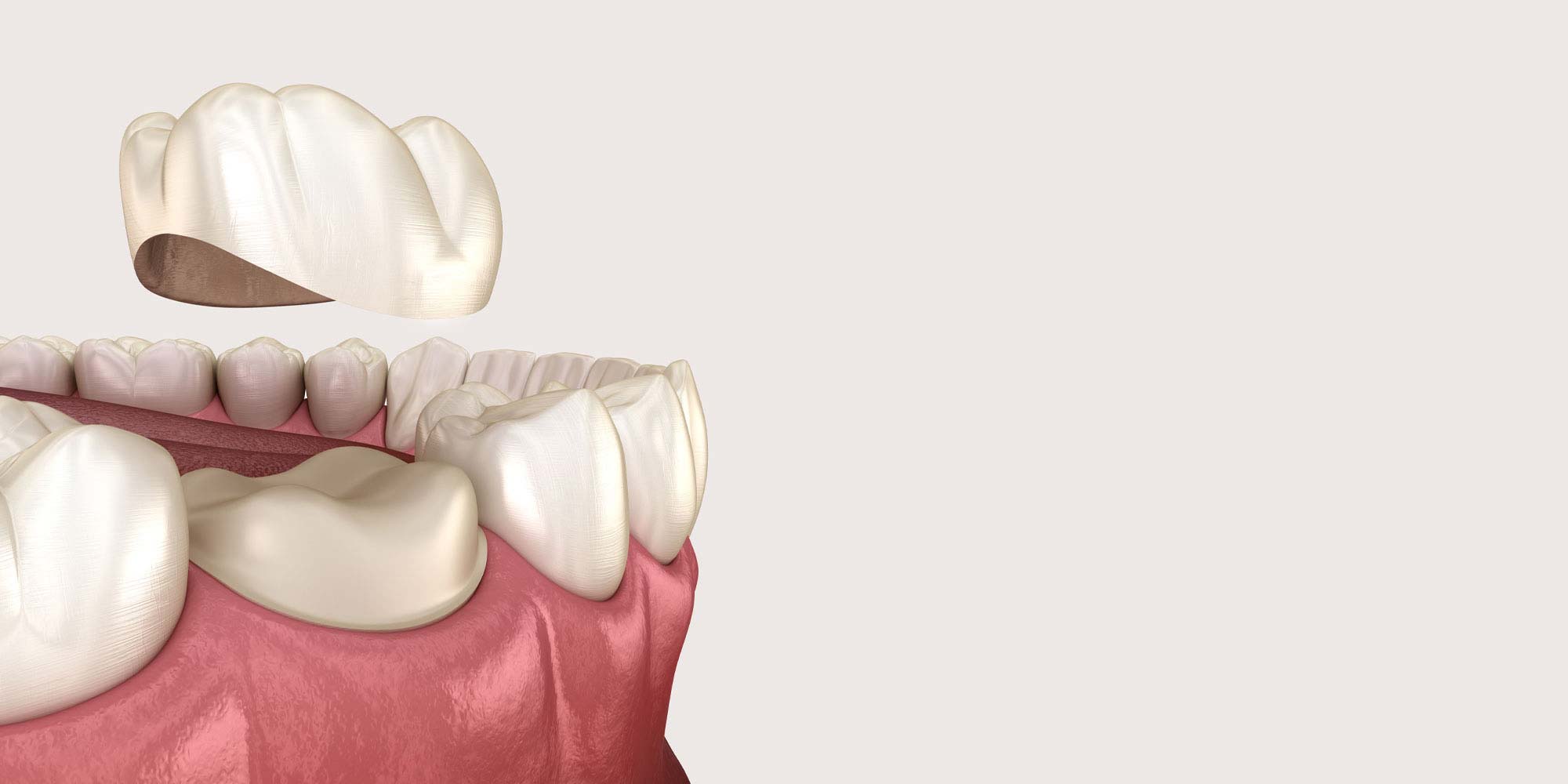 a model of a dental crown being placed on a tooth
