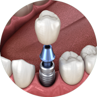 a model of a dental implant