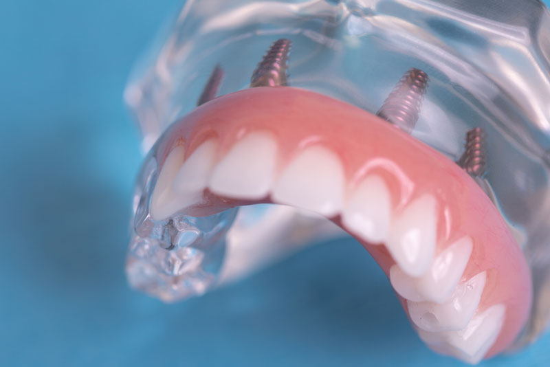 a full mouth dental implant model in san antoniot tx.