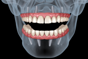 a black and white picture of a patients x-ray image of their skeleton head with the all-on-4 dental implants highlighted in it in color.