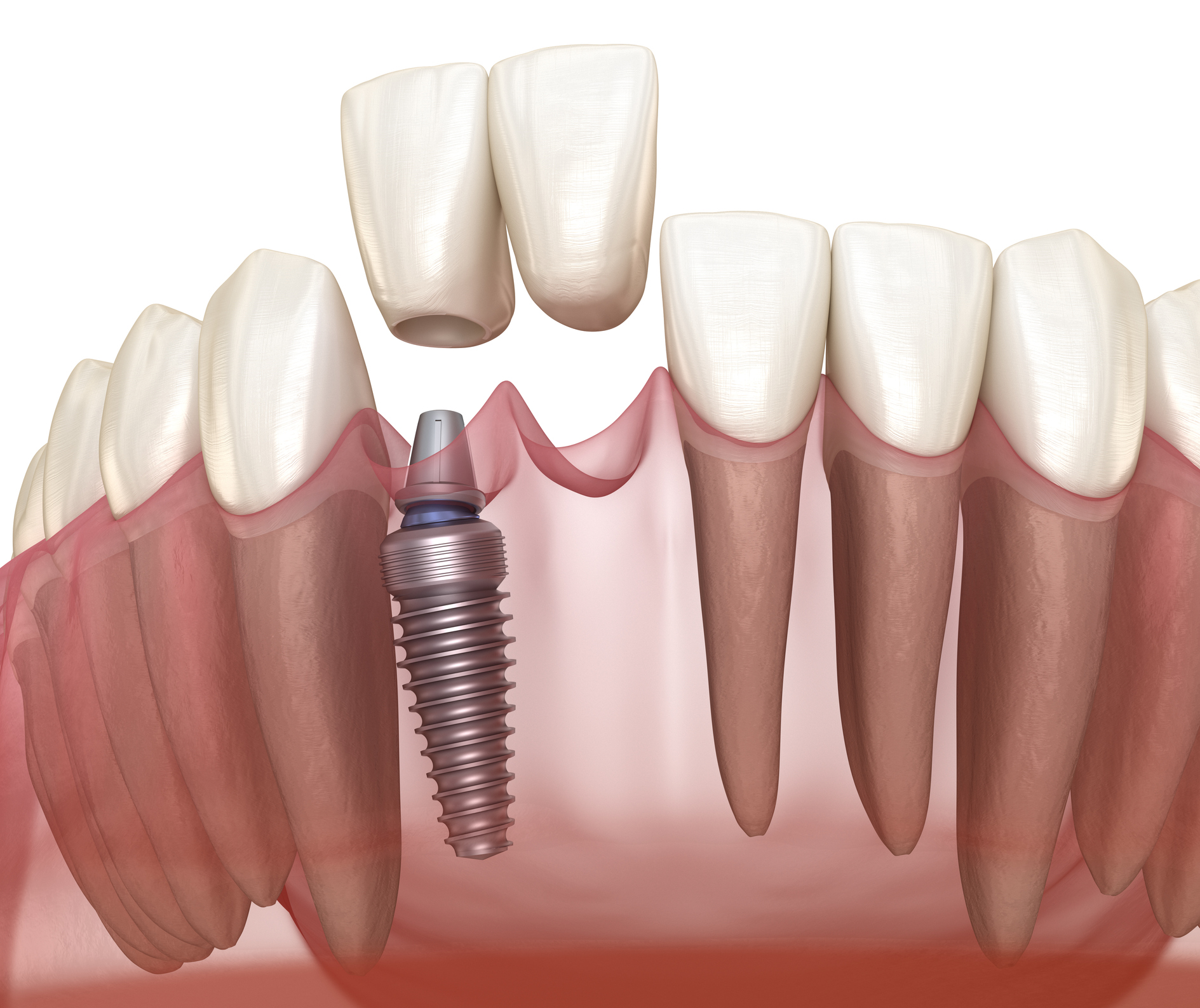 are dental implants painful