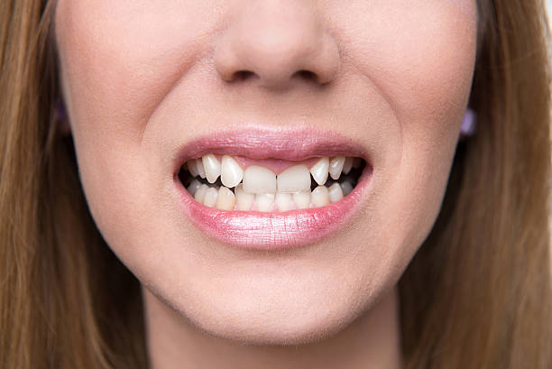 best cosmetic dentistry options for crooked teeth