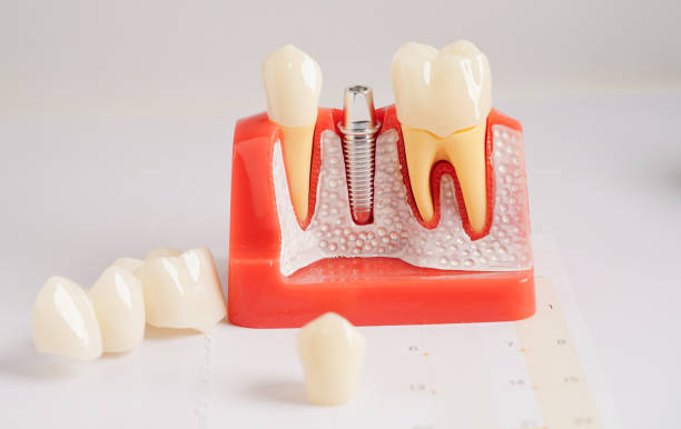 how dental implants work to replace missing teeth
